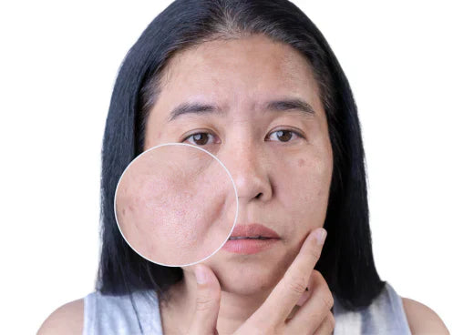 How to Treat Dark Spots and Hyperpigmentation with Microneedling?